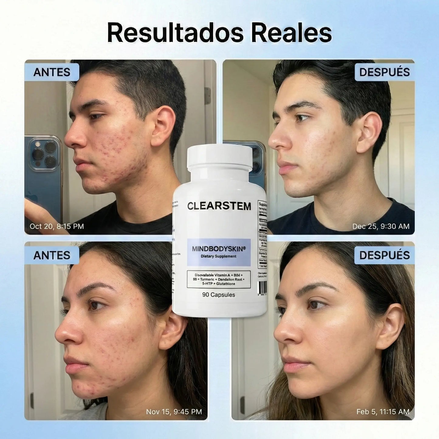 MINDBODYSKIN® - Acaba con el Acné Hormonal en 7 Días. (Copia)
