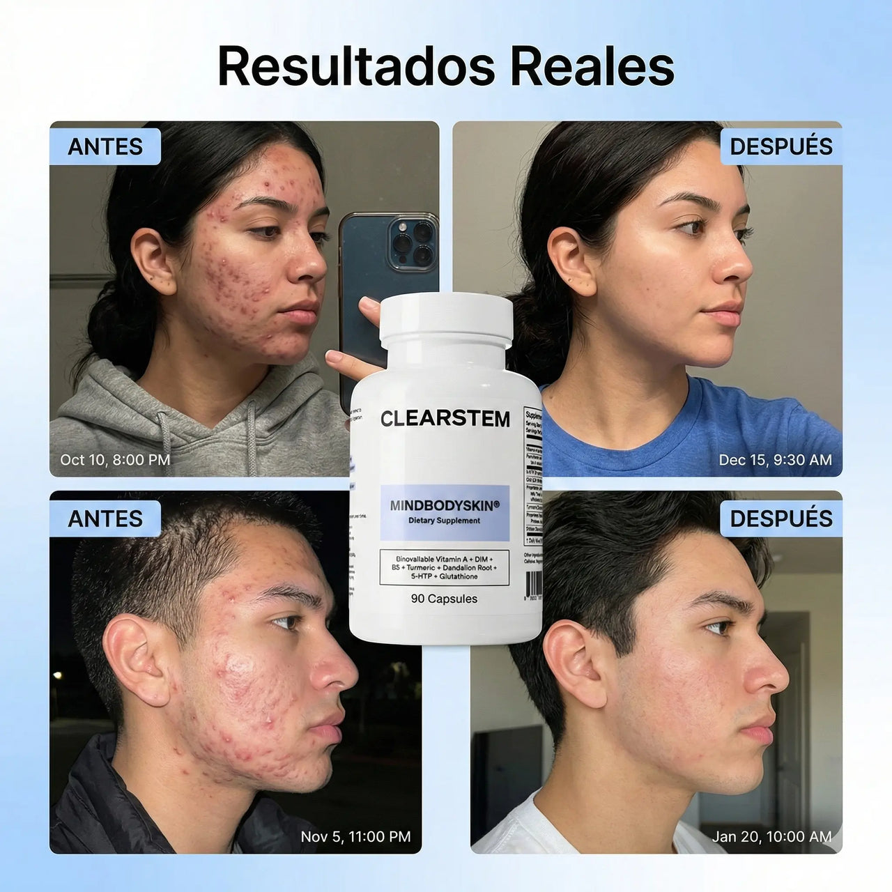 MINDBODYSKIN® - Acaba con el Acné Hormonal en 7 Días.