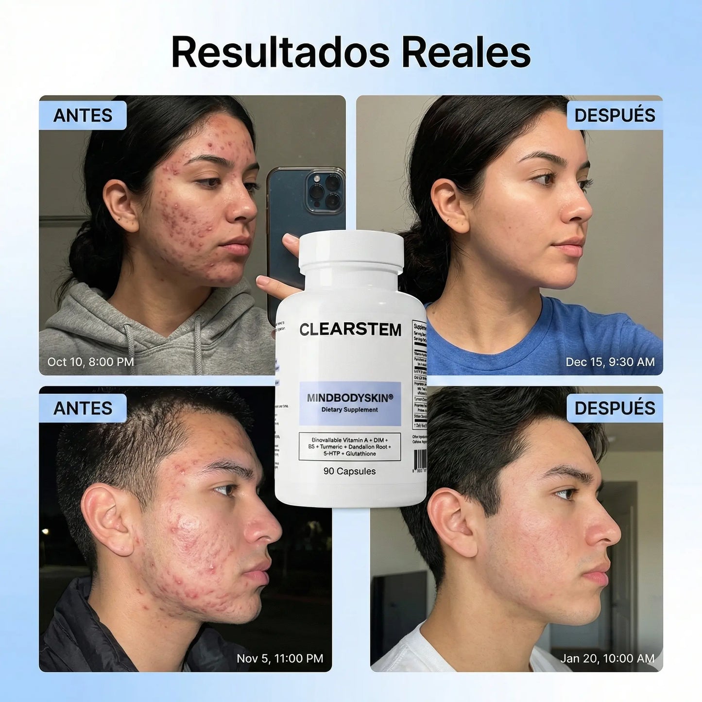 MINDBODYSKIN® - Acaba con el Acné Hormonal en 7 Días. (Copia)