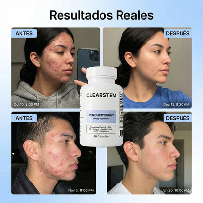 MINDBODYSKIN® - Acaba con el Acné Hormonal en 7 Días. (Copia)