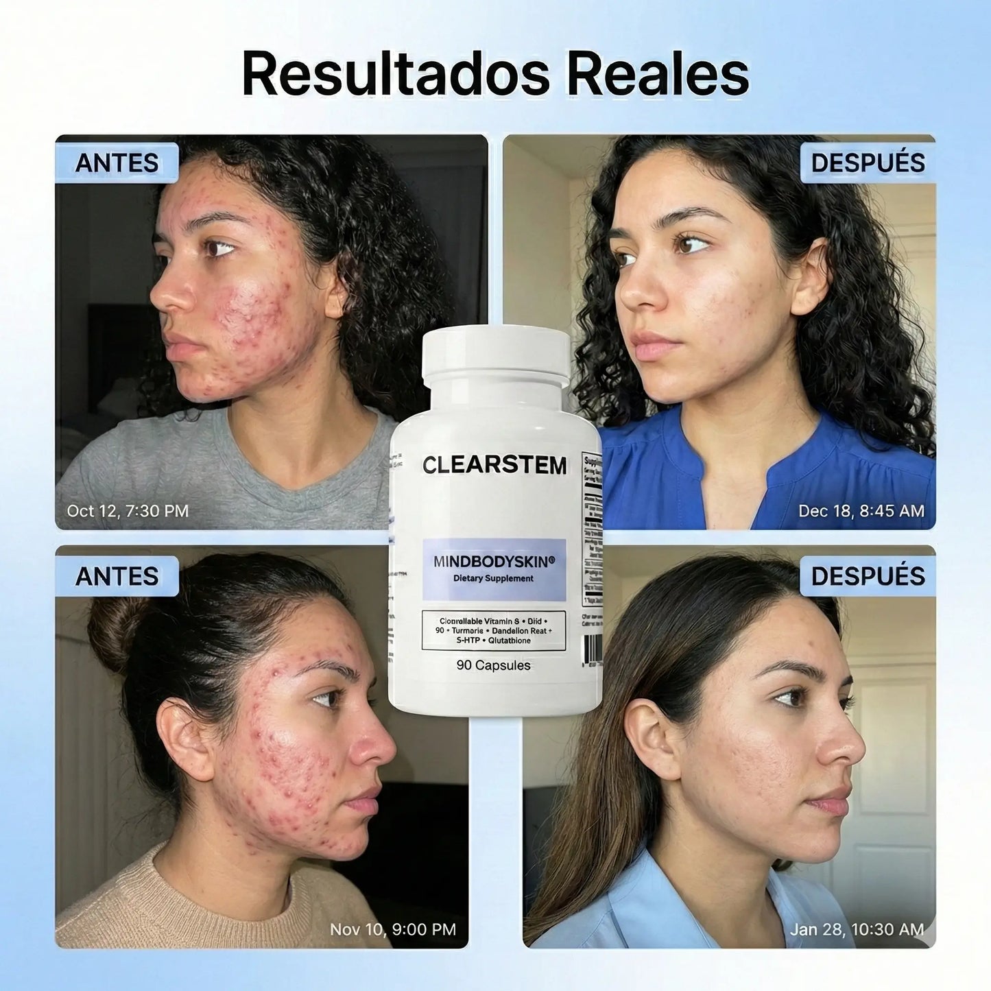 MINDBODYSKIN® - Acaba con el Acné Hormonal en 7 Días. (Copia)